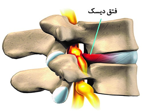 دیسك ستون فقرات